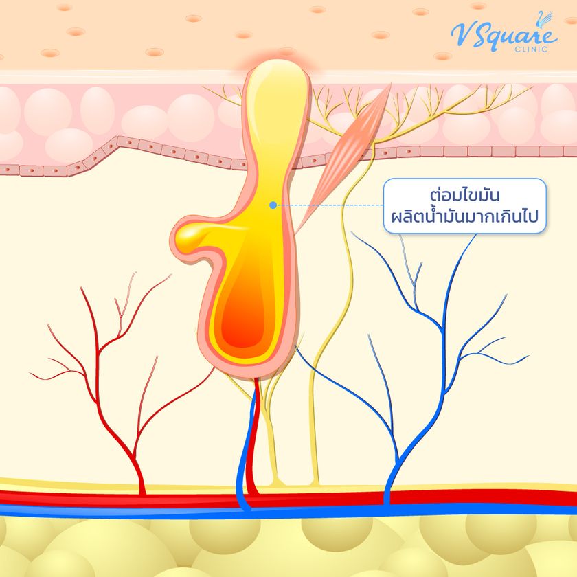 ต่อมไขมันผลิตน้ำมันมากเกินไป