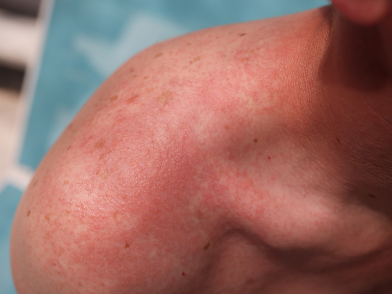 Sunblock กับ Sunscreen ต่างกันอย่างไร ในการช่วยปกป้องผิว