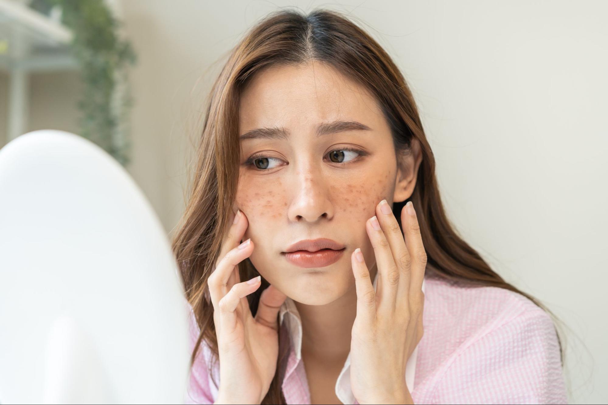 จุดด่างดําบนใบหน้า เกิดจากอะไร