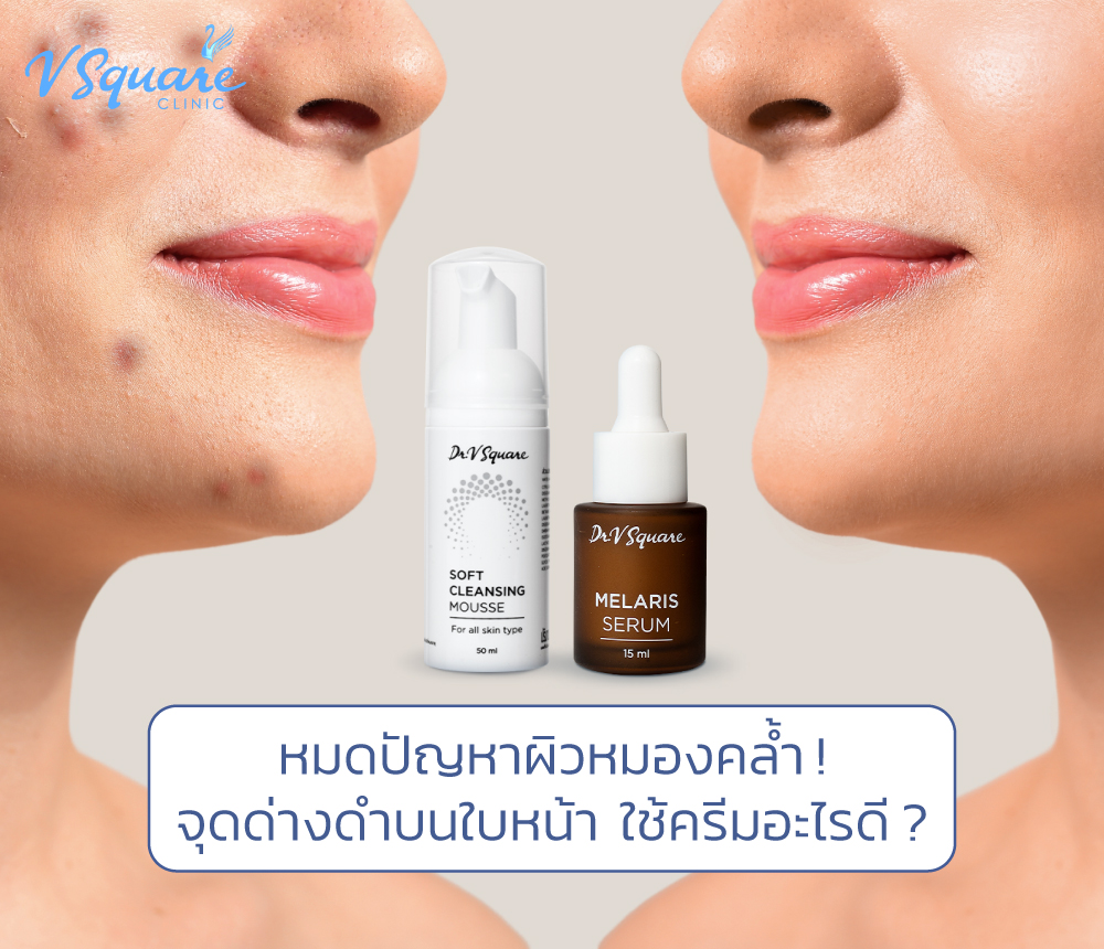 จุดด่างดําบนใบหน้า ใช้ครีมอะไรดี