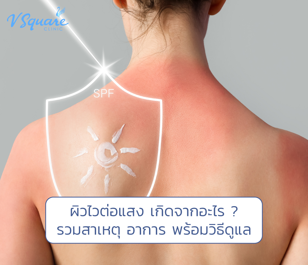 ผิวไวต่อแสง