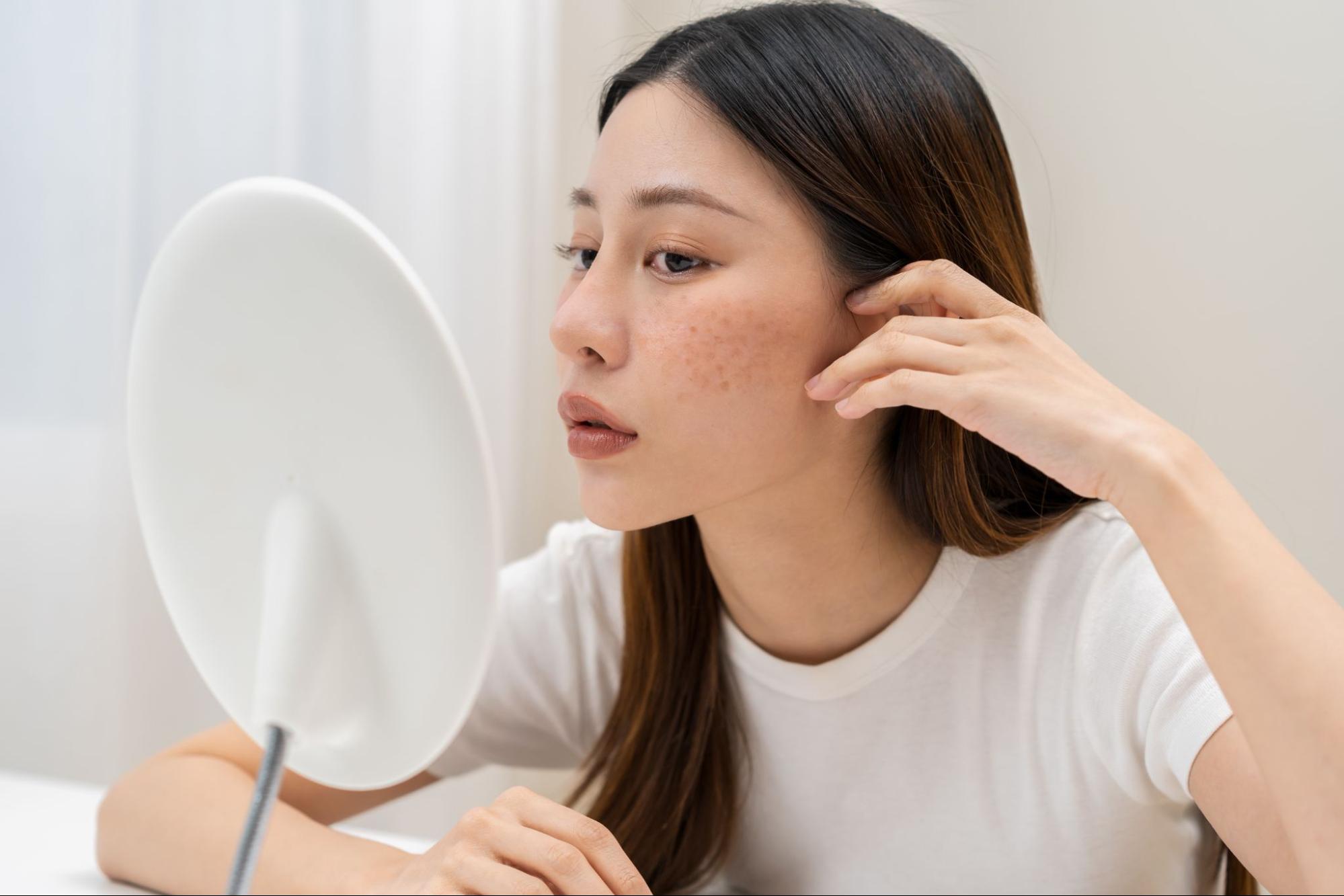 รักษาจุดด่างดําบนใบหน้าด้วยวิธีเร่งด่วน VS แบบธรรมชาติ ต่างกันไหม
