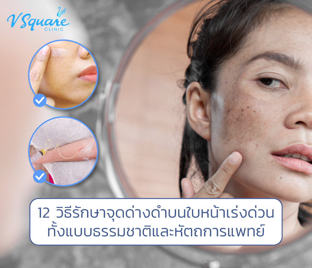 รักษาจุดด่างดําบนใบหน้าเร่งด่วน