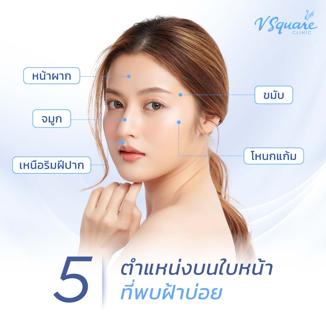 ตำแหน่งที่มักเกิดฝ้า