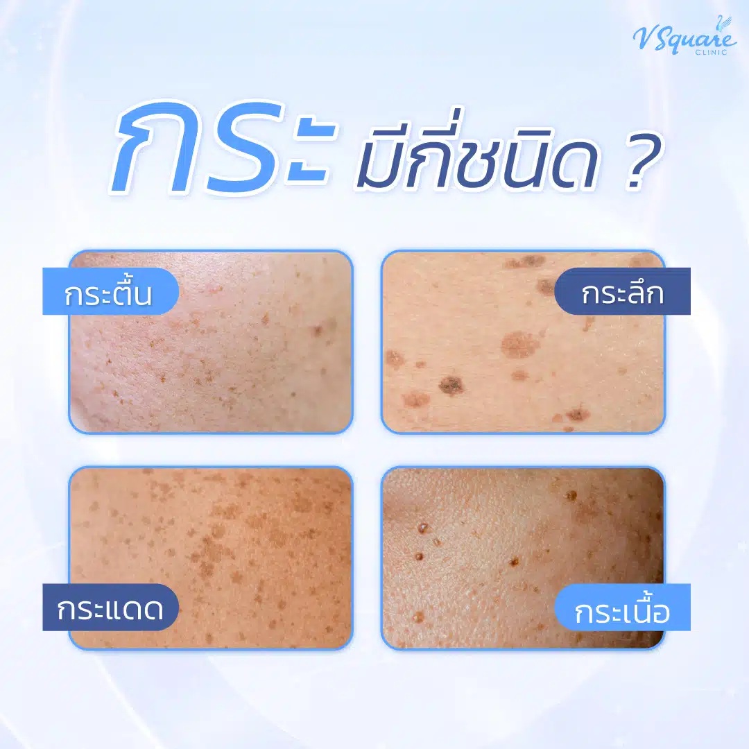 ประเภทกระที่พบบ่อย