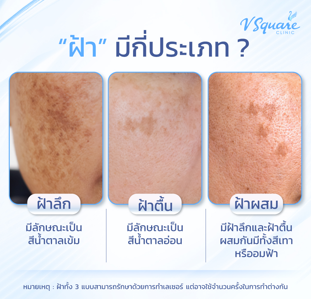 ประเภทฝ้า