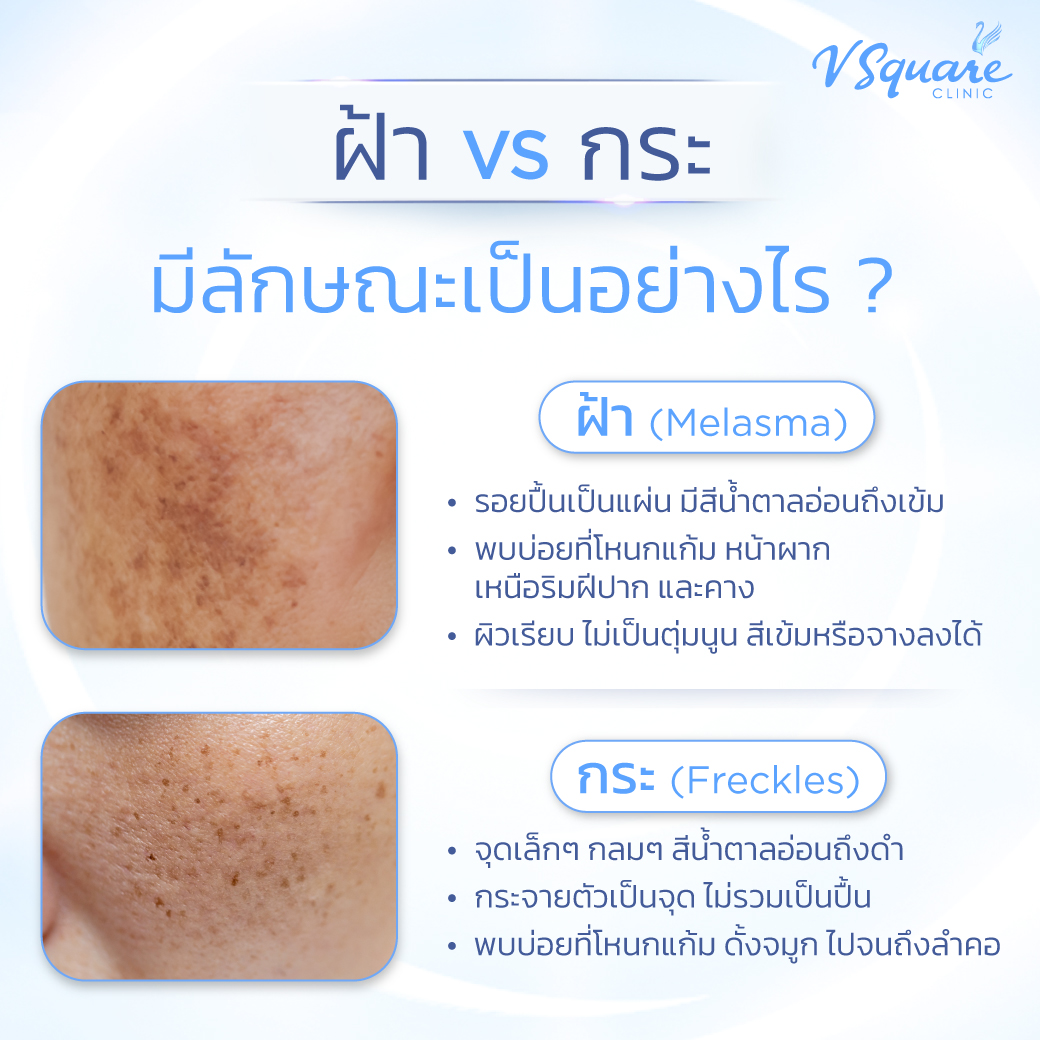 ฝ้า กระ