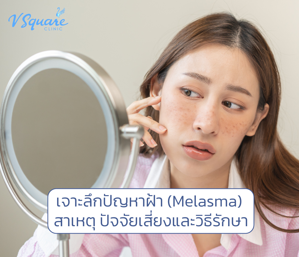 ฝ้า