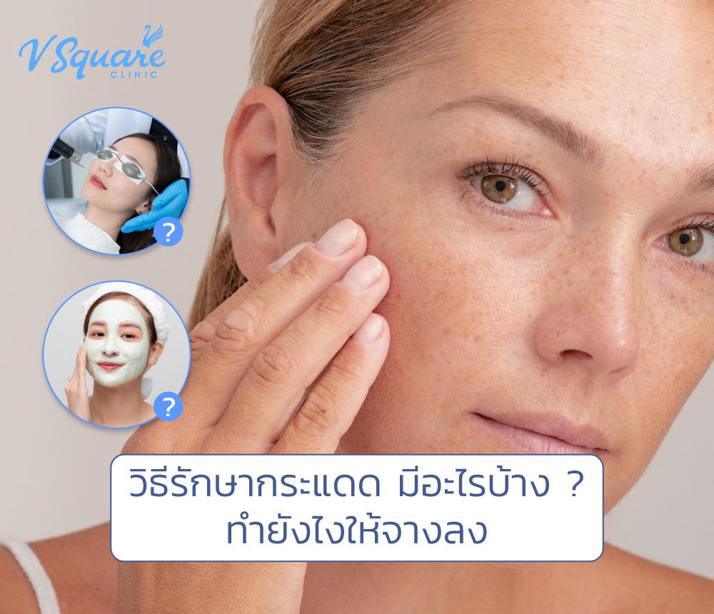 รักษากระแดด